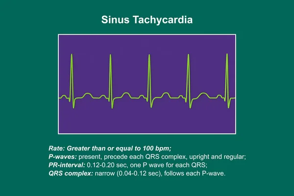 エレクトロカルディオグラム Ecg 心拍数が通常の心臓リズムで 成人の通常の90 100Bpmの上限より高い心臓リズムを表示し 3Dイラスト — ストック写真