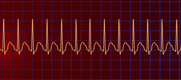 Ecg Taquicardia Supraventricular Uma Frequência Cardíaca Rápida Que Origina Acima — Fotografia de Stock
