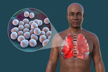 Şeffaf derisi olan bir adamın üst yarısını gösteren 3 boyutlu bir fotorealistik çizim akciğerlerin zatürreeden etkilendiğini ve Staphylococcus aureus bakterisinin yakın plan görüntüsünü ortaya çıkarıyor..