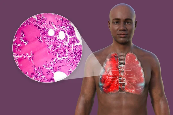 A 3D photorealistic illustration showcasing the upper half part of a man with transparent skin, revealing the lungs affected by pneumonia, along with a micrograph image of pneumonia.