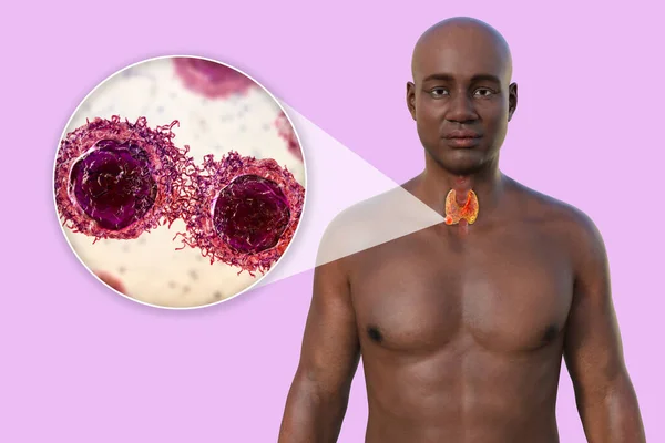 Thyroid Cancer Illustration Showcasing Man Transparent Skin Revealing Tumour Thyroid — Stock Photo, Image