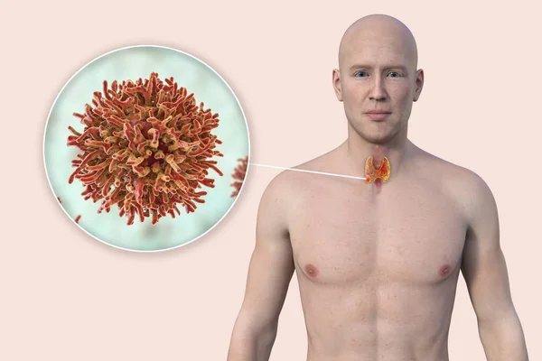 Thyroid Cancer Illustration Showcasing Man Transparent Skin Revealing Tumour Thyroid — Stock Photo, Image