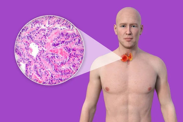 Thyroid cancer. 3D illustration showcasing a man with transparent skin, revealing a tumour in thyroid gland along with photomicrograph of thyroid cancer.