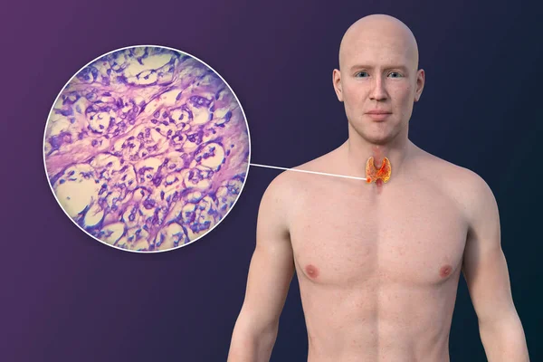 Thyroid cancer. 3D illustration showcasing a man with transparent skin, revealing a tumour in thyroid gland along with photomicrograph of thyroid cancer.