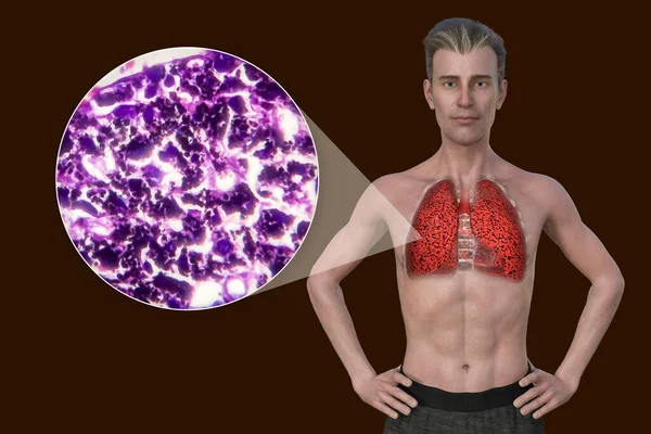 A 3D illustration of the upper half part of a man with transparent skin, revealing the condition of smoker\'s lungs, along with a micrograph image of lungs affected by smoking.