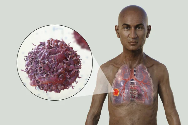 Lung Cancer Photorealistic Illustration Upper Half Part Man Transparent Skin — Stock Photo, Image
