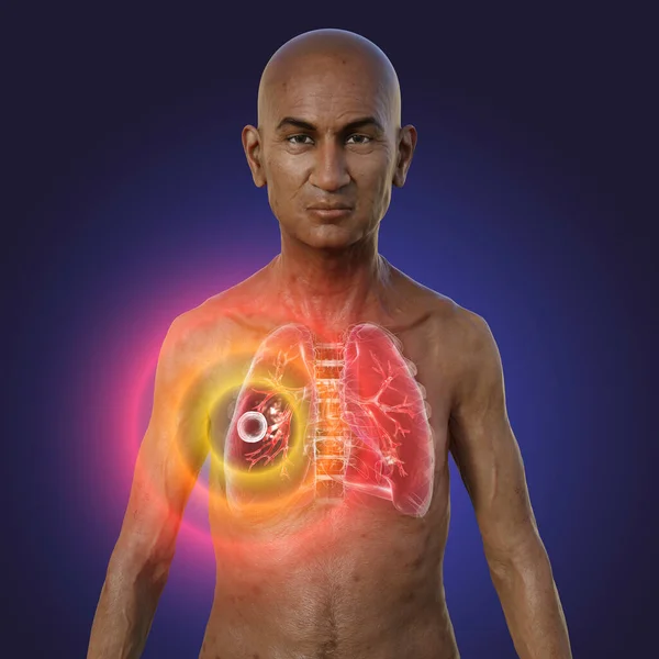 A 3D photorealistic illustration of the upper half of a man with transparent skin, showcasing the lungs affected by cavernous tuberculosis.