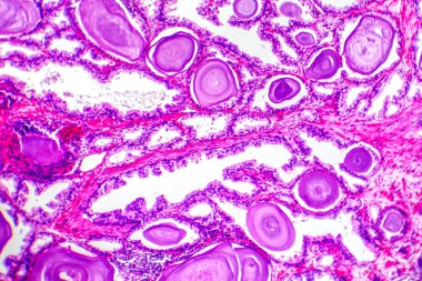 Protez hiperplazma mikrografı, artan salgı dokusu gösteriyor..