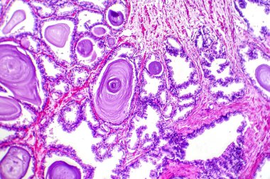 Protez hiperplazma mikrografı, artan salgı dokusu gösteriyor..