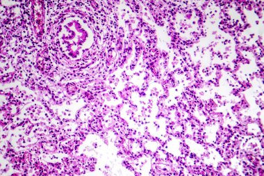 Bronkozmoninin fotomikrografı, bakteriyel enfeksiyondan kaynaklanan iltihap ve akciğer dokusunun konsolidasyonunu gösteriyor..