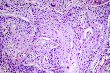 Akciğerin skuamöz hücre kanserinin fotokopisi, akciğer dokusunda habis squamous hücreleri gösteriyor..