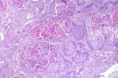 Akciğerin skuamöz hücre kanserinin fotokopisi, akciğer dokusunda habis squamous hücreleri gösteriyor..