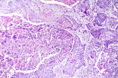 Akciğerin skuamöz hücre kanserinin fotokopisi, akciğer dokusunda habis squamous hücreleri gösteriyor..