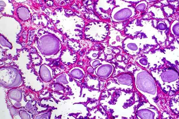 Mikrographie Der Prostatahyperplasie Mit Erhöhtem Drüsengewebe — Stockfoto