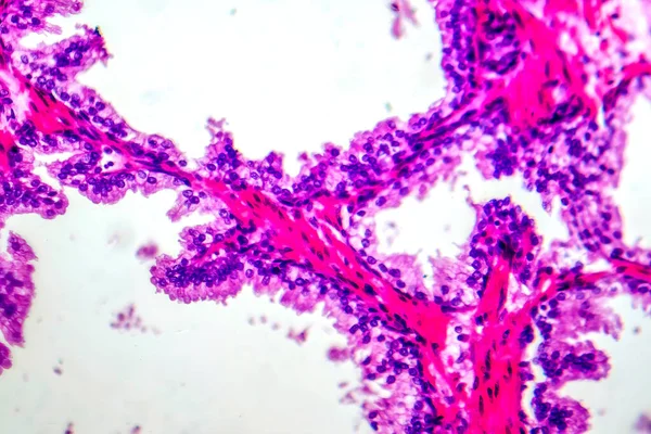 増加した腺組織を示す前立腺過剰症のマイクログラフ — ストック写真
