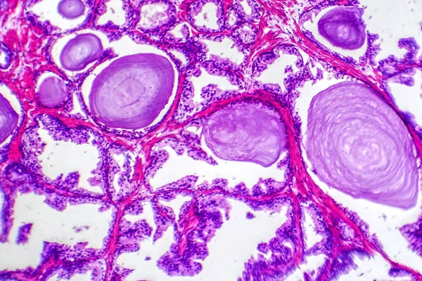 Mikrograf Prostatahyperplasi Visar Ökad Körtelvävnad — Stockfoto