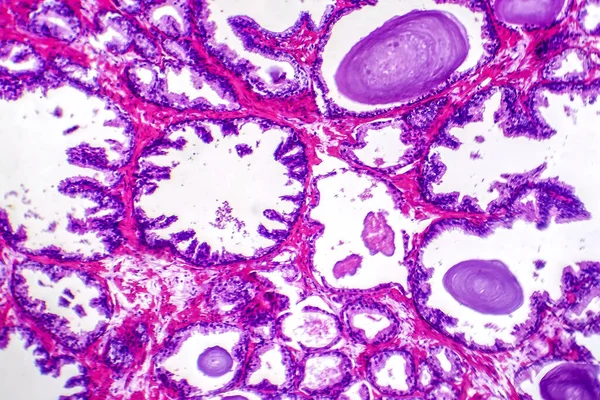 Mikrograf Prostatahyperplasi Visar Ökad Körtelvävnad — Stockfoto