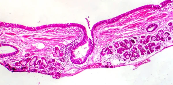 기관지 Squamous Metaplasia의 Photomicrograph 안대기에서 Squamous 변환을 보여주는 — 스톡 사진
