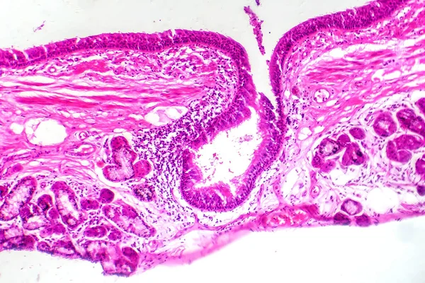 支气管上皮鳞状增生的显微照片 显示呼吸内膜鳞状细胞的变化 — 图库照片