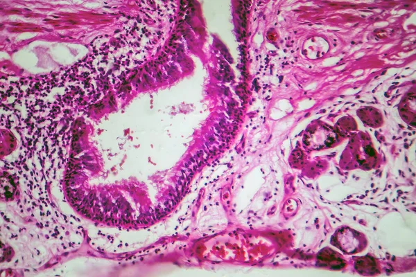 Photomicrograph Bronchial Epithelial Squamous Metaplasia Showing Squamous Cell Transformation Respiratory — Stock Photo, Image