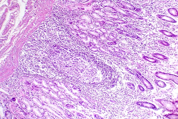 Photomicrograph of intestinal metaplasia, displaying transformation of stomach lining cells into intestinal-like cells.