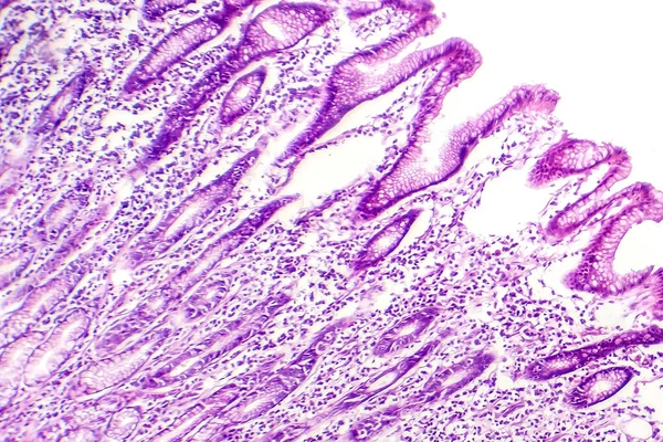 Fotomikrograf Metaplazji Jelit Wykazujący Przemianę Komórek Podszewki Żołądka Komórki Podobne — Zdjęcie stockowe