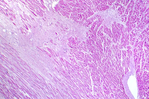 Photomicrographie Infarctus Myocarde Montrant Des Tissus Cardiaques Endommagés Raison Une — Photo