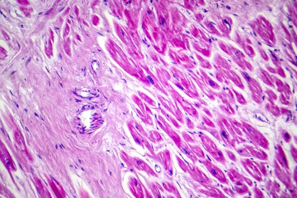 Miyokard Enfarktüsünün Fotomikroskobu Kan Akışının Azalması Hücre Ölümünün Neden Olduğu — Stok fotoğraf