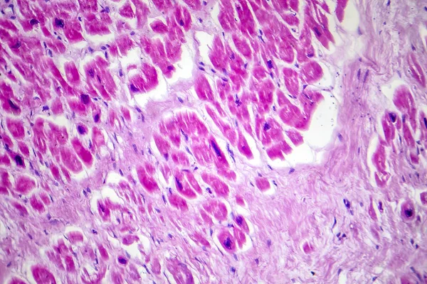 Photomicrograph of myocardial infarction, showing damaged heart tissue due to reduced blood supply and cell death.