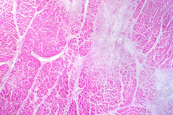 Fotomicrogramma Infarto Miocardico Che Mostra Tessuto Cardiaco Danneggiato Causa Ridotto — Foto Stock