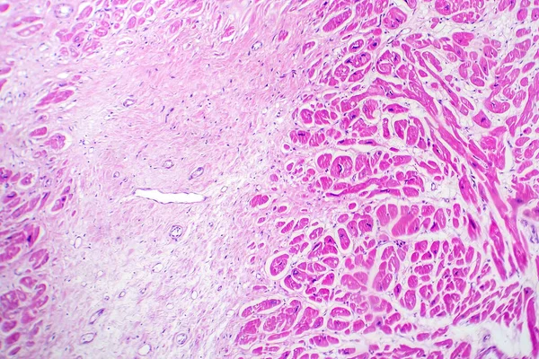 Myocardialis Infarctus Fotomikrográfja Amely Csökkent Vérellátás Sejthalál Következtében Károsodott Szívszövetet — Stock Fotó