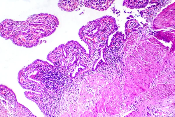 Photomicrograph Chronic Cholecystitis Showcasing Inflammation Structural Changes Gallbladder Wall — Stock Photo, Image