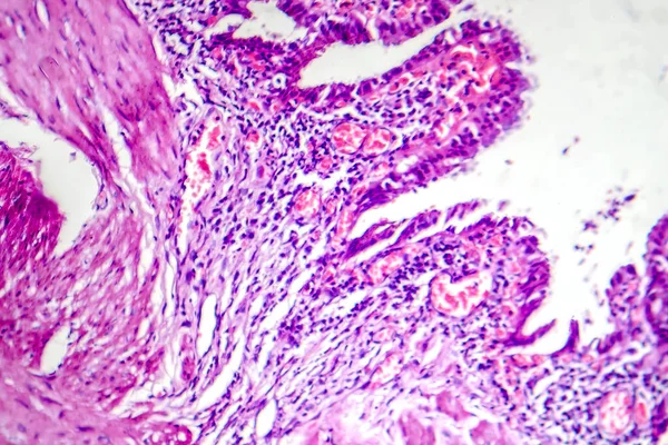 Photomicrograph Chronic Cholecystitis Showcasing Inflammation Structural Changes Gallbladder Wall — Stock Photo, Image