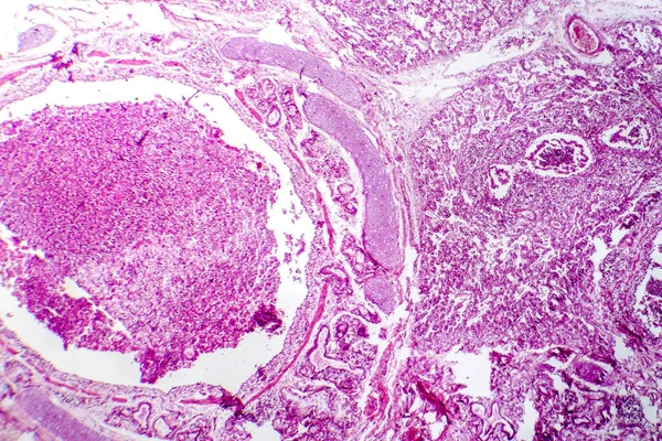 Fotomikrograf Bronchopneumonie Ilustrující Zánět Konsolidaci Plicní Tkáně Důsledku Bakteriální Infekce — Stock fotografie