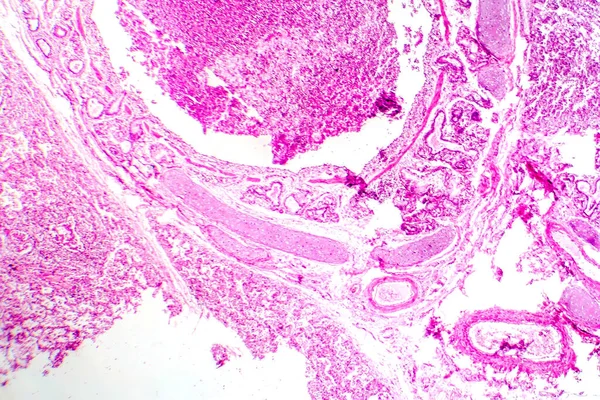 Фотомікрограф Бронхопневмонії Ілюструє Запалення Консолідацію Тканин Легень Внаслідок Бактеріальної Інфекції — стокове фото