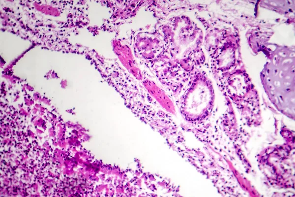 支气管肺炎的显微照片 显示因细菌性感染而引起的炎症及肺组织巩固 — 图库照片