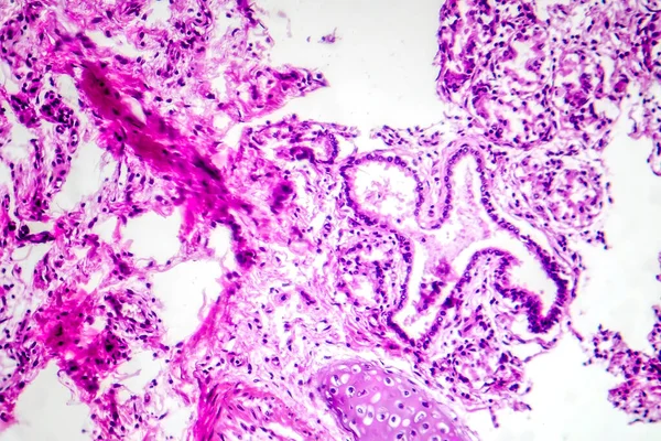 Fotomicrografia Broncopneumonia Ilustrando Inflamação Consolidação Tecido Pulmonar Devido Infecção Bacteriana — Fotografia de Stock