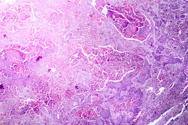 Fotomikrograf Dlaždicobuněčného Karcinomu Plic Ukazující Zhoubné Dlaždicové Buňky Plicní Tkáni — Stock fotografie