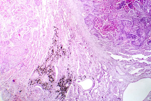 肺鳞状细胞癌影像学表现为肺组织恶性鳞状细胞 — 图库照片