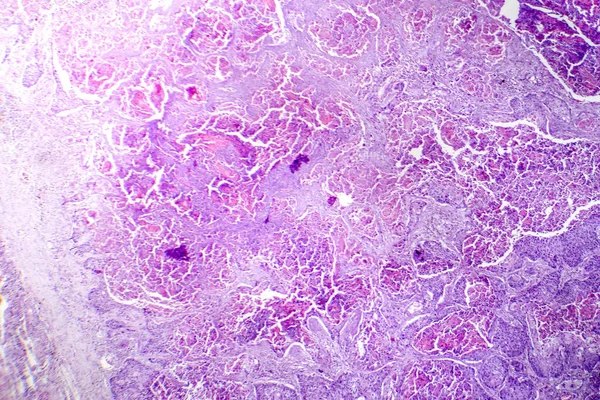 Tüdő Laphámsejtes Carcinomájának Fotomikrográfja Rosszindulatú Laphámsejteket Mutat Tüdőszövetben — Stock Fotó