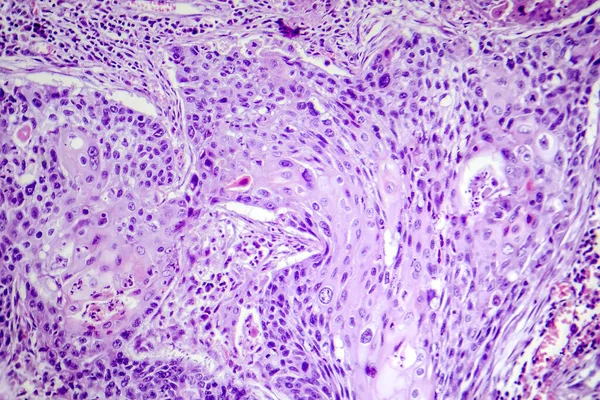 Fotomicrografía Del Carcinoma Células Escamosas Pulmón Que Muestra Células Escamosas — Foto de Stock