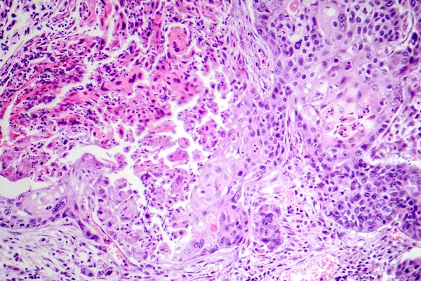 肺鳞状细胞癌影像学表现为肺组织恶性鳞状细胞 — 图库照片