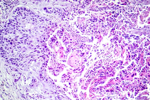 Photomicrograph Squamous Cell Carcinoma Lung Showing Malignant Squamous Cells Lung — Stock Photo, Image