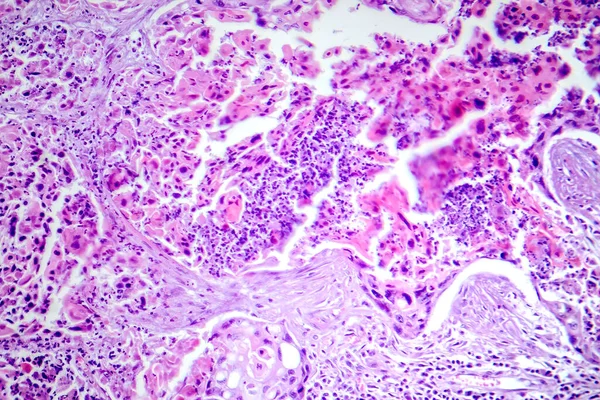 Tüdő Laphámsejtes Carcinomájának Fotomikrográfja Rosszindulatú Laphámsejteket Mutat Tüdőszövetben — Stock Fotó