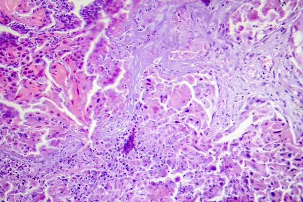 Akciğerin Skuamöz Hücre Kanserinin Fotokopisi Akciğer Dokusunda Habis Squamous Hücreleri — Stok fotoğraf