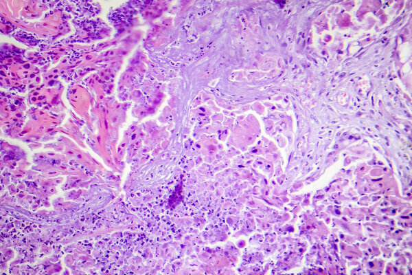 Photomicrograph of squamous cell carcinoma of the lung, showing malignant squamous cells in lung tissue.