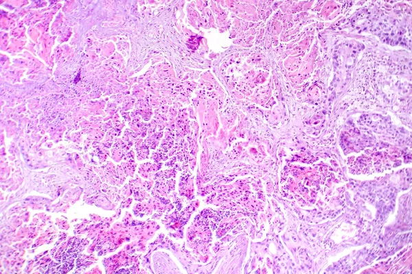 Fotomicrografia Carcinoma Espinocelular Pulmão Mostrando Células Escamosas Malignas Tecido Pulmonar — Fotografia de Stock