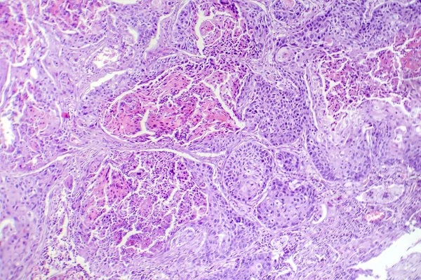 Photomicrograph of squamous cell carcinoma of the lung, showing malignant squamous cells in lung tissue.