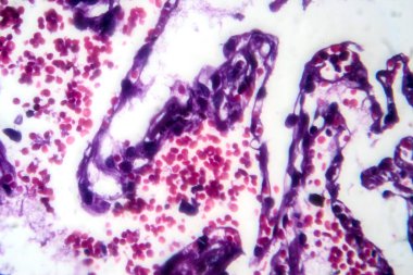 Sigara içen kişinin akciğerinin fotomikroskobu, uzun süreli sigara içme alışkanlıkları ile ilişkili karakteristik değişiklikleri ve hasarları ortaya koymaktadır..