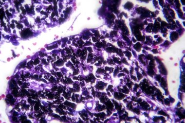 Sigara içen kişinin akciğerinin fotomikroskobu, uzun süreli sigara içme alışkanlıkları ile ilişkili karakteristik değişiklikleri ve hasarları ortaya koymaktadır..